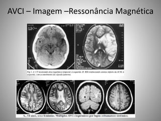 AVCI – Imagem –Ressonância Magnética
 