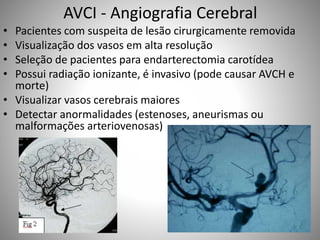 AVCI - Angiografia Cerebral
• Pacientes com suspeita de lesão cirurgicamente removida
• Visualização dos vasos em alta resolução
• Seleção de pacientes para endarterectomia carotídea
• Possui radiação ionizante, é invasivo (pode causar AVCH e
morte)
• Visualizar vasos cerebrais maiores
• Detectar anormalidades (estenoses, aneurismas ou
malformações arteriovenosas)
 
