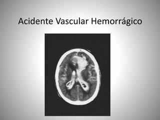 Acidente Vascular Hemorrágico
 
