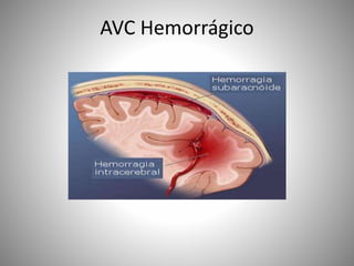 AVC Hemorrágico
 