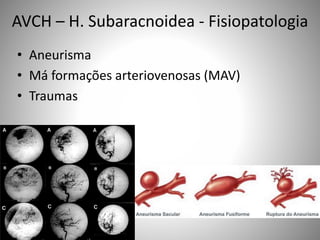 AVCH – H. Subaracnoidea - Fisiopatologia
• Aneurisma
• Má formações arteriovenosas (MAV)
• Traumas
 