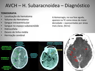 TOMOGRAFIA
• Localização do hematoma
• Volume do Hematoma
• Sangue intraventricular
• Sangue no espaço subaracnóide
• Hidrocefalia
• Desvio de linha média
• Herniação cerebral
AVCH – H. Subaracnoidea – Diagnóstico
A Hemorragia, na sua fase aguda,
aparece na TC como áreas de maior
densidade – representadas por áreas
mais claras. (ferro)
 