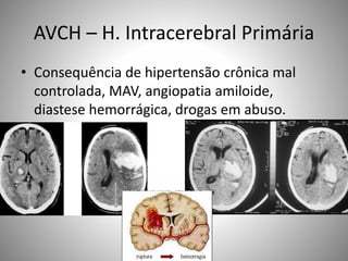 AVCH – H. Intracerebral Primária
• Consequência de hipertensão crônica mal
controlada, MAV, angiopatia amiloide,
diastese hemorrágica, drogas em abuso.
 