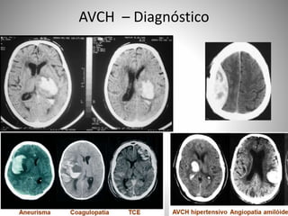 AVCH – Diagnóstico
 