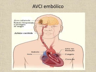 AVCI embólico
 