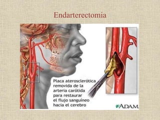 Endarterectomia
 