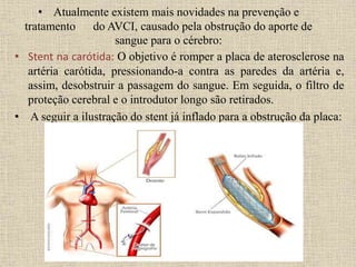 • Atualmente existem mais novidades na prevenção e
tratamento do AVCI, causado pela obstrução do aporte de
sangue para o cérebro:
• Stent na carótida: O objetivo é romper a placa de aterosclerose na
artéria carótida, pressionando-a contra as paredes da artéria e,
assim, desobstruir a passagem do sangue. Em seguida, o filtro de
proteção cerebral e o introdutor longo são retirados.
• A seguir a ilustração do stent já inflado para a obstrução da placa:
 