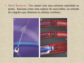 • Merci Retriever: Um cateter com uma estrutura espiralada na
ponta, funciona como uma espécie de saca-rolhas, na retirada
de coágulos que obstruem as artérias cerebrais.
 