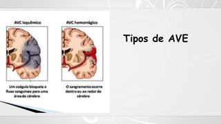 Tipos de AVE
 