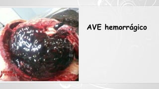 AVE hemorrágico
 