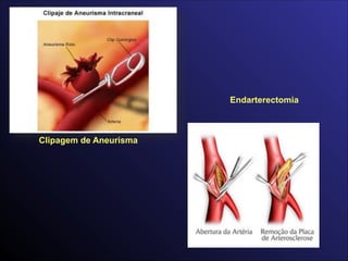 Endarterectomia
Clipagem de Aneurisma
 