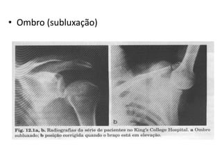 • Ombro (subluxação)
 