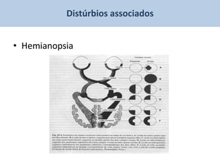 Distúrbios associados


• Hemianopsia
 