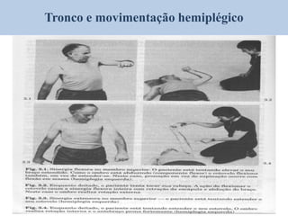 Tronco e movimentação hemiplégico
 