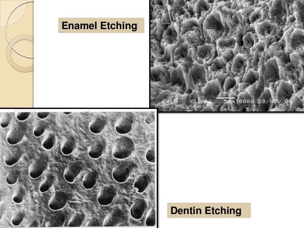 Acid Etching of Enamel and Bond Strength