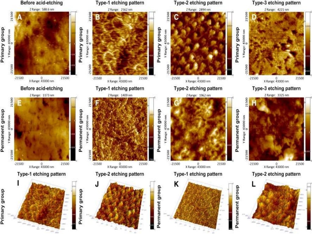 Acid Etching of Enamel and Bond Strength