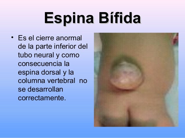 AnencefaliaAnencefalia
• Es el cierre anormal
del extremo superior
del tubo neural en
donde el cerebro no
se desarrolla
co...