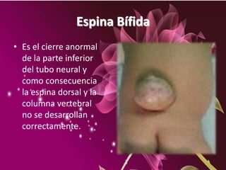 Espina Bífida
• Es el cierre anormal
de la parte inferior
del tubo neural y
como consecuencia
la espina dorsal y la
columna vertebral
no se desarrollan
correctamente.
 