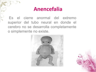 Anencefalia
Es el cierre anormal del extremo
superior del tubo neural en donde el
cerebro no se desarrolla completamente
o simplemente no existe.
 