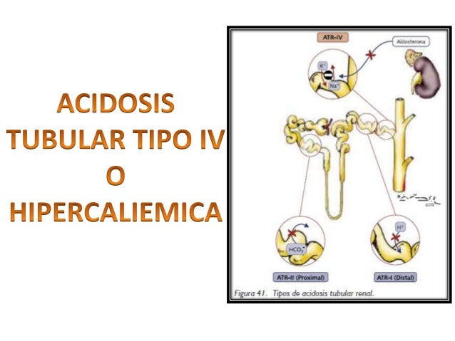 Acidosis tubular renal tipo 2 y 4