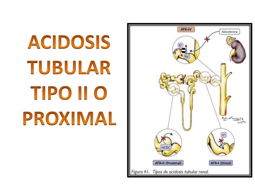 Acidosis tubular renal tipo 2 y 4