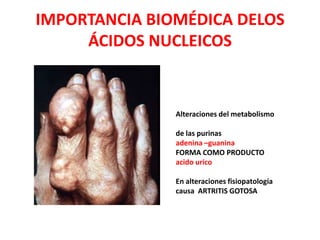 IMPORTANCIA BIOMÉDICA DELOS
ÁCIDOS NUCLEICOS
Alteraciones del metabolismo
de las purinas
adenina –guanina
FORMA COMO PRODUCTO
acido urico
En alteraciones fisiopatología
causa ARTRITIS GOTOSA
 