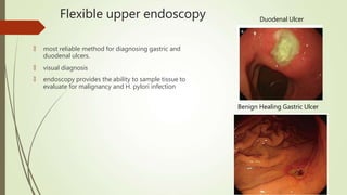 Flexible upper endoscopy
🠶 most reliable method for diagnosing gastric and
duodenal ulcers.
🠶 visual diagnosis
🠶 endoscopy provides the ability to sample tissue to
evaluate for malignancy and H. pylori infection
Duodenal Ulcer
Benign Healing Gastric Ulcer
 