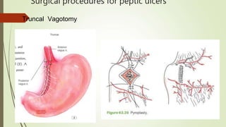 Surgical procedures for peptic ulcers
Truncal Vagotomy
 