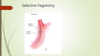 Selective Vagotomy
 