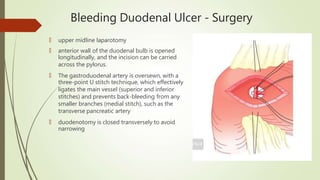 Bleeding Duodenal Ulcer - Surgery
🠶 upper midline laparotomy
🠶 anterior wall of the duodenal bulb is opened
longitudinally, and the incision can be carried
across the pylorus.
🠶 The gastroduodenal artery is oversewn, with a
three-point U stitch technique, which effectively
ligates the main vessel (superior and inferior
stitches) and prevents back-bleeding from any
smaller branches (medial stitch), such as the
transverse pancreatic artery
🠶 duodenotomy is closed transversely to avoid
narrowing
 