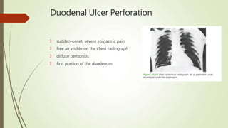 Duodenal Ulcer Perforation
🠶 sudden-onset, severe epigastric pain
🠶 free air visible on the chest radiograph
🠶 diffuse peritonitis
🠶 first portion of the duodenum
 