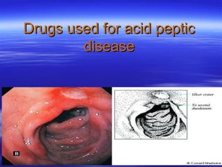 Drugs used for acid peptic
disease

 