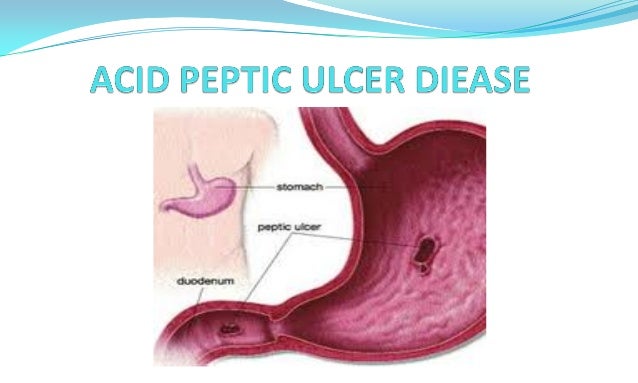 peptic ulcer thomas peptic ulcer thomas