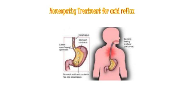 Acid Reflux Ppt acid reflux ppt