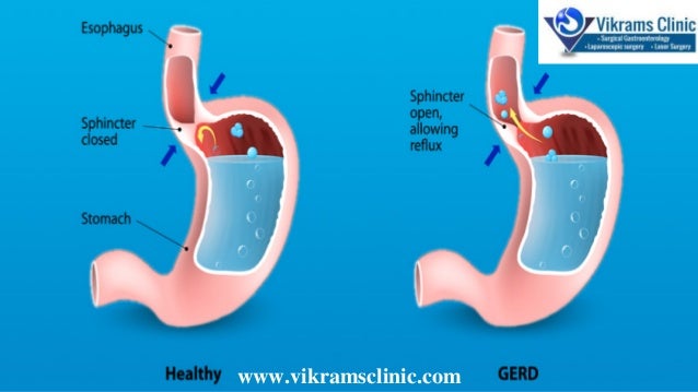 Acid Reflux Treatment In Chennai | Gastroenterologist In ...