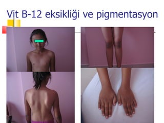 Vit B-12 eksikliği ve pigmentasyon
 
