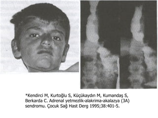 *Kendirci M, Kurtoğlu S, Küçükaydın M, Kumandaş S,
Berkarda C. Adrenal yetmezlik-alakrima-akalazya (3A)
sendromu. Çocuk Sağ Hast Derg 1995;38:401-5.
 