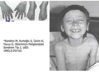 *Kendirci M, Kurtoğlu S, Üzüm K,
Yavuz Ü. Otoimmün Poliglandüler
Sendrom Tip 1. UED
1993;3:257-62.
 