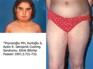*Poyrazoğlu MH, Kurtoğlu S,
Aydın K. İatrojenik Cushing
Sendromu. Klinik Bilimler
Pediatri 1997;3:731-733.
 