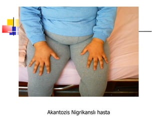 Akantozis Nigrikanslı hasta
 