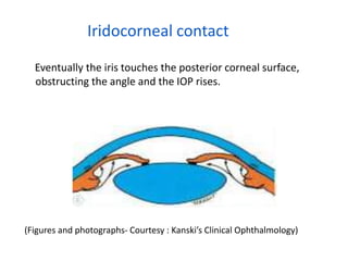 Iridocorneal contact
Eventually the iris touches the posterior corneal surface,
obstructing the angle and the IOP rises.
(Figures and photographs- Courtesy : Kanski’s Clinical Ophthalmology)
 