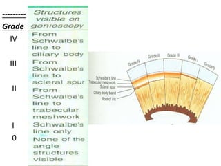---------
Grade
IV
III
II
I
0
 