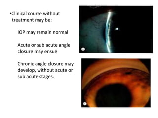 •Clinical course without
treatment may be:
IOP may remain normal
Acute or sub acute angle
closure may ensue
Chronic angle closure may
develop, without acute or
sub acute stages.
 