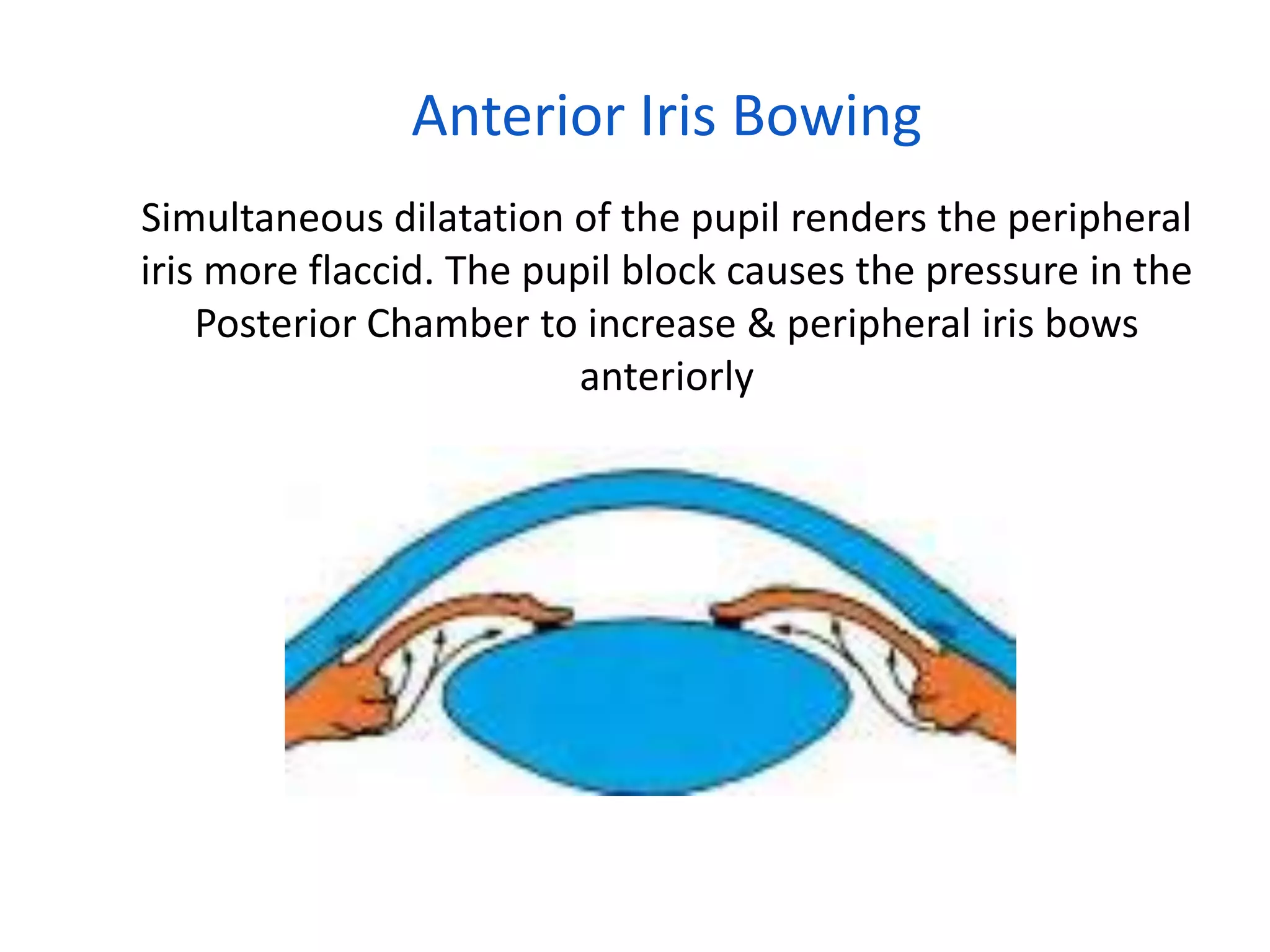 Anterior Iris Bowing
Simultaneous dilatation of the pupil renders the peripheral
iris more flaccid. The pupil block causes the pressure in the
Posterior Chamber to increase & peripheral iris bows
anteriorly
 