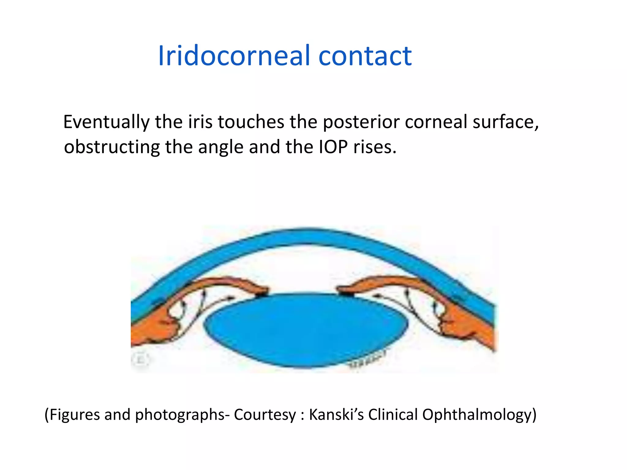 Iridocorneal contact
Eventually the iris touches the posterior corneal surface,
obstructing the angle and the IOP rises.
(Figures and photographs- Courtesy : Kanski’s Clinical Ophthalmology)
 