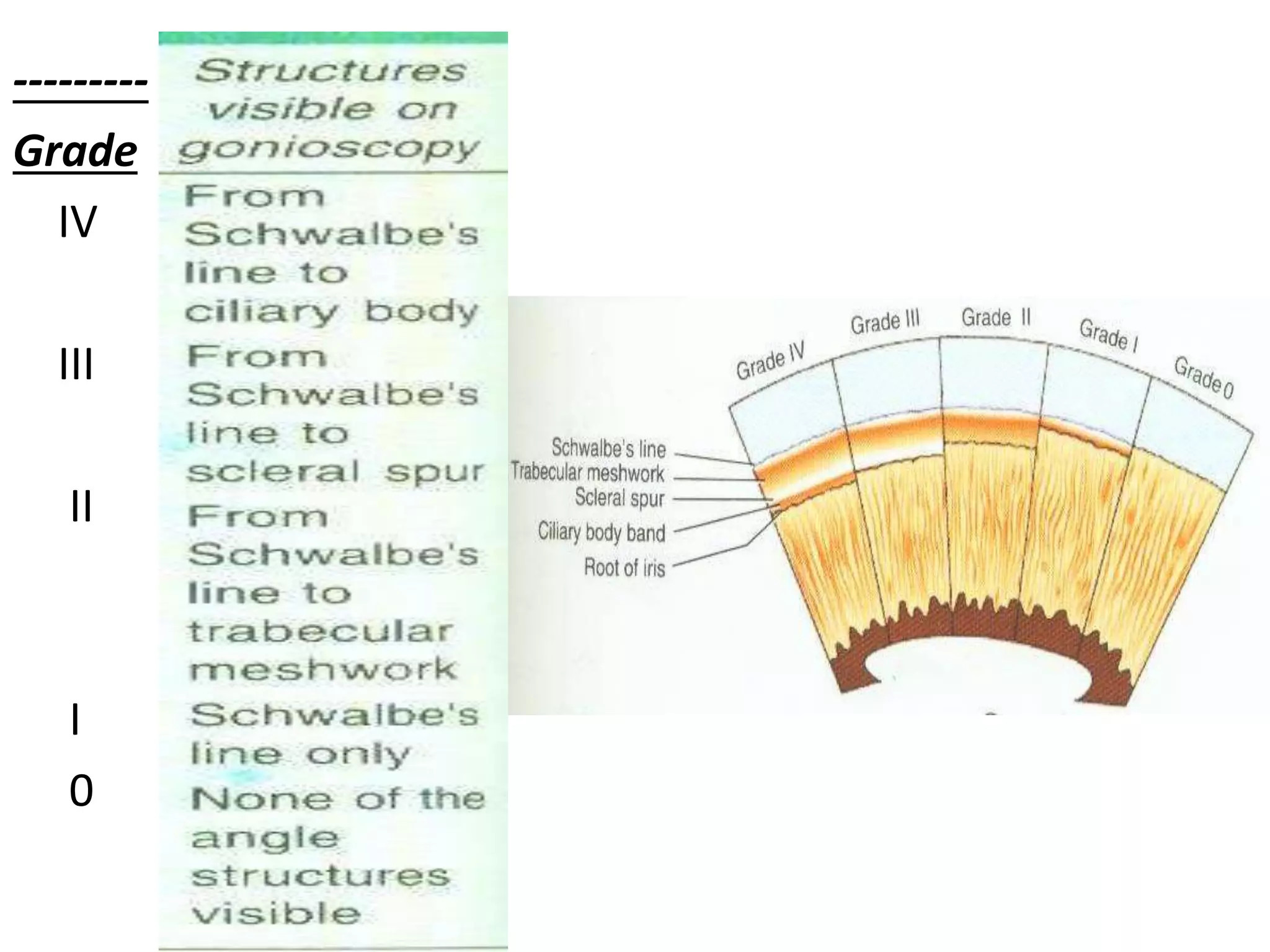 ---------
Grade
IV
III
II
I
0
 