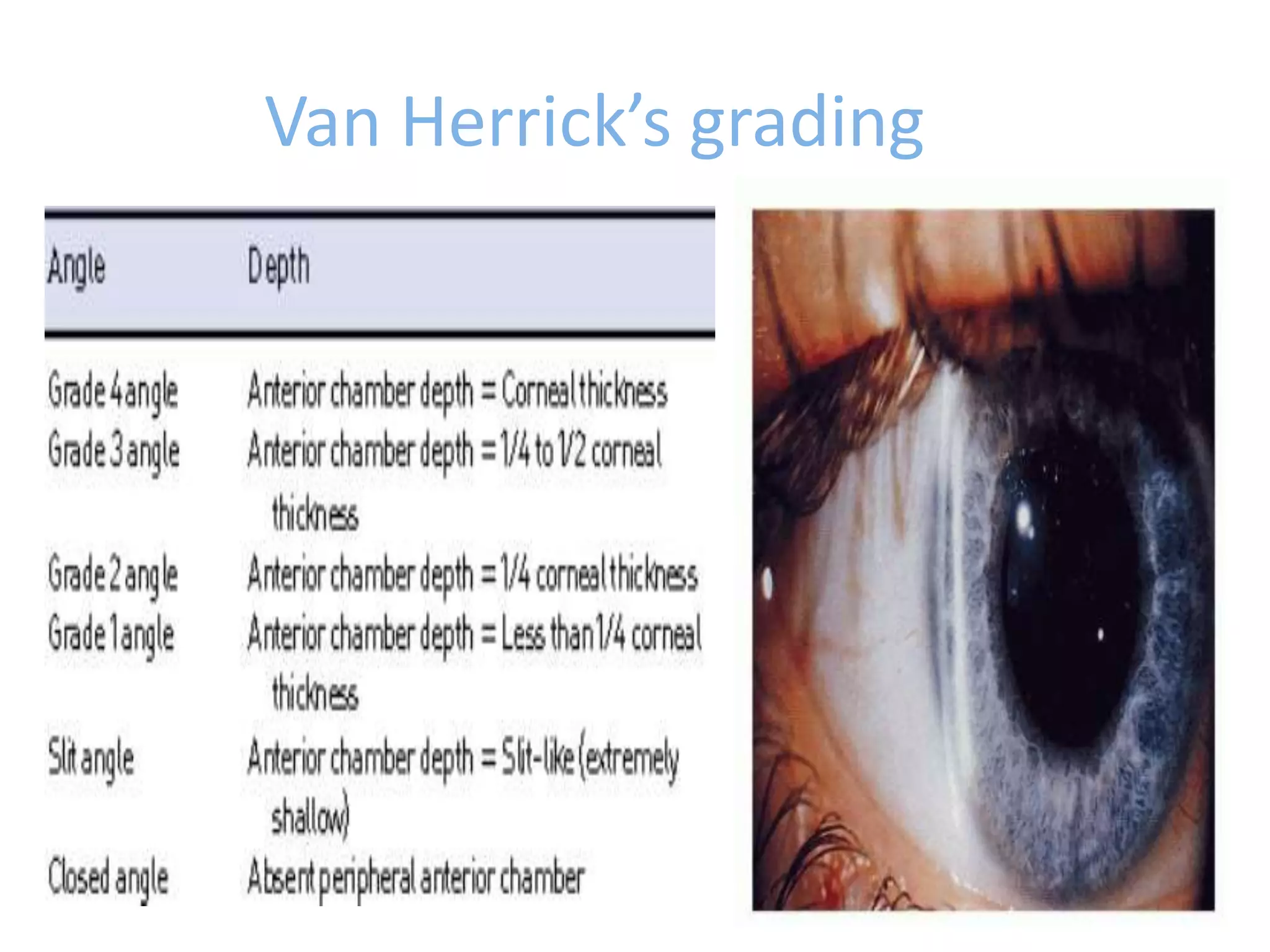 Van Herrick’s grading
 