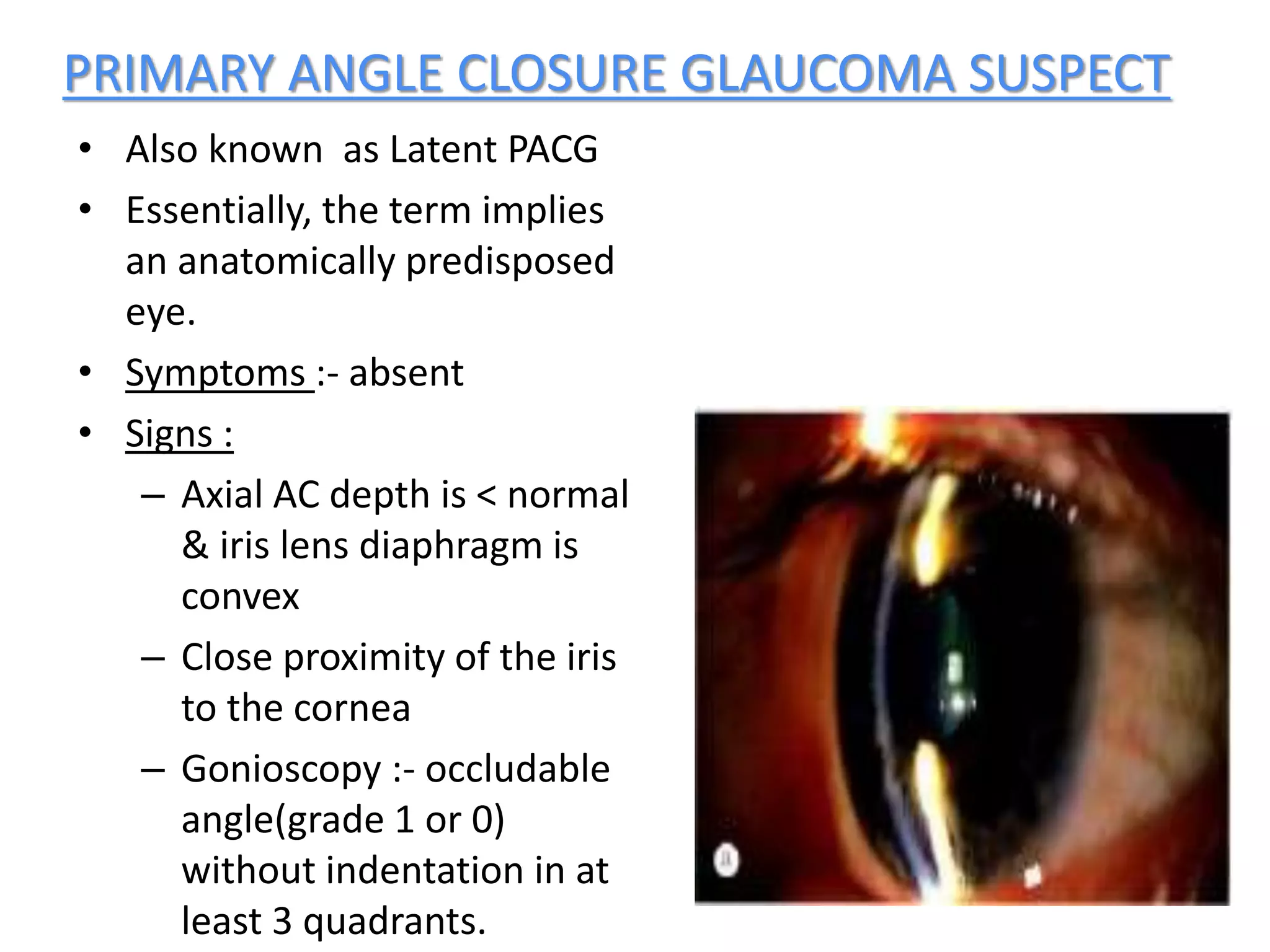 PRIMARY ANGLE CLOSURE GLAUCOMA SUSPECT
• Also known as Latent PACG
• Essentially, the term implies
an anatomically predisposed
eye.
• Symptoms :- absent
• Signs :
– Axial AC depth is < normal
& iris lens diaphragm is
convex
– Close proximity of the iris
to the cornea
– Gonioscopy :- occludable
angle(grade 1 or 0)
without indentation in at
least 3 quadrants.
 