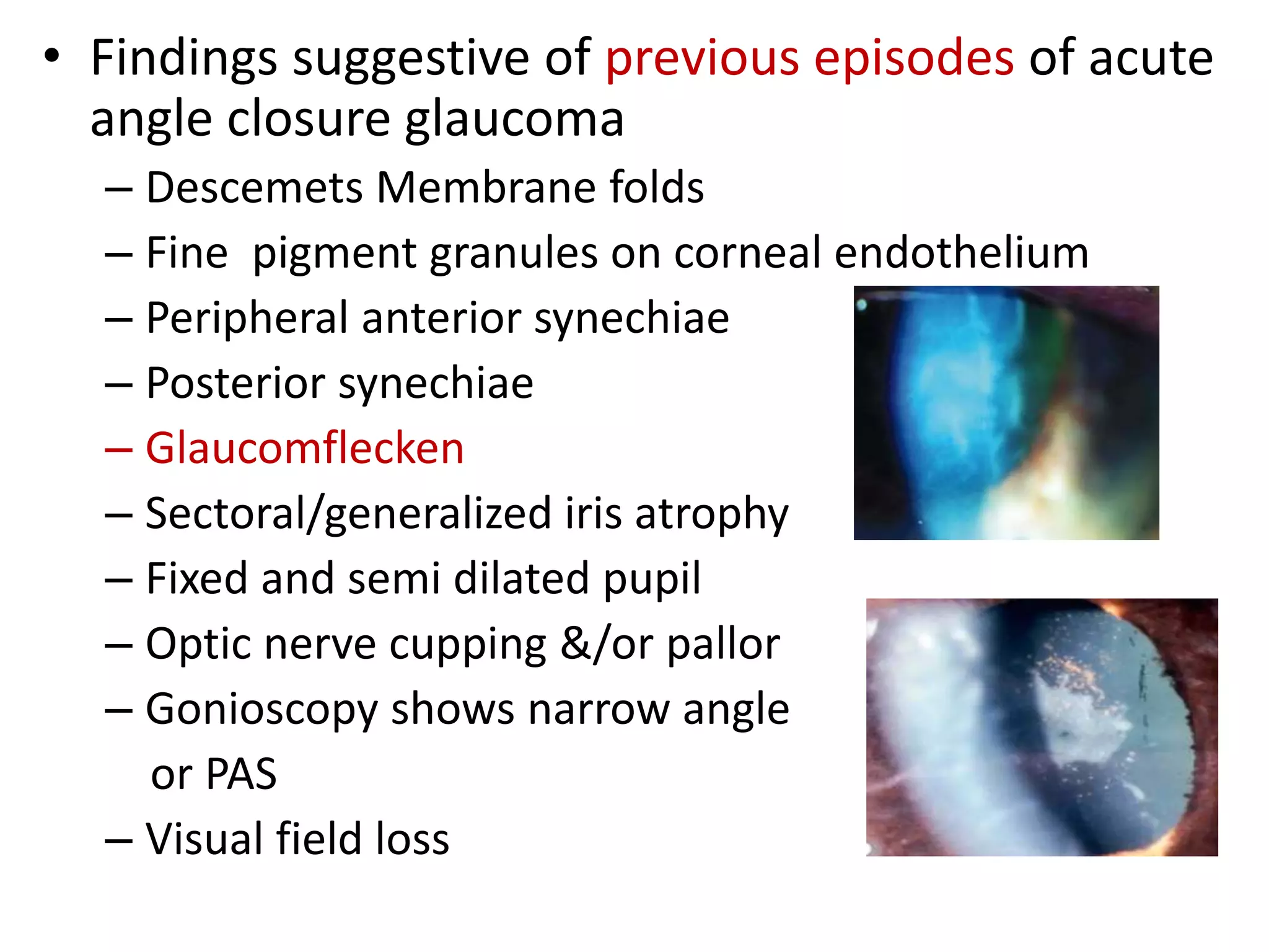 • Findings suggestive of previous episodes of acute
angle closure glaucoma
– Descemets Membrane folds
– Fine pigment granules on corneal endothelium
– Peripheral anterior synechiae
– Posterior synechiae
– Glaucomflecken
– Sectoral/generalized iris atrophy
– Fixed and semi dilated pupil
– Optic nerve cupping &/or pallor
– Gonioscopy shows narrow angle
or PAS
– Visual field loss
 