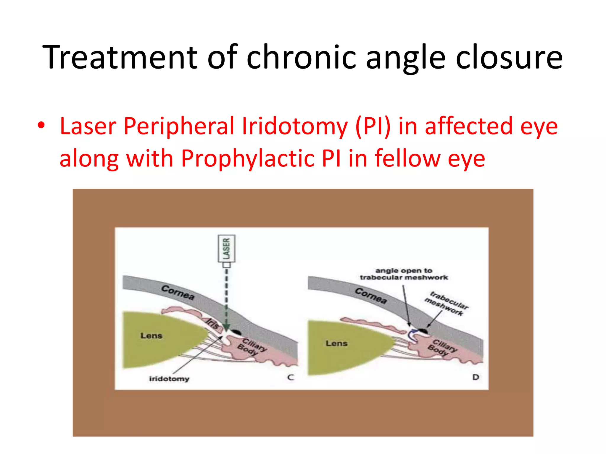 Treatment of chronic angle closure
• Laser Peripheral Iridotomy (PI) in affected eye
along with Prophylactic PI in fellow eye
 
